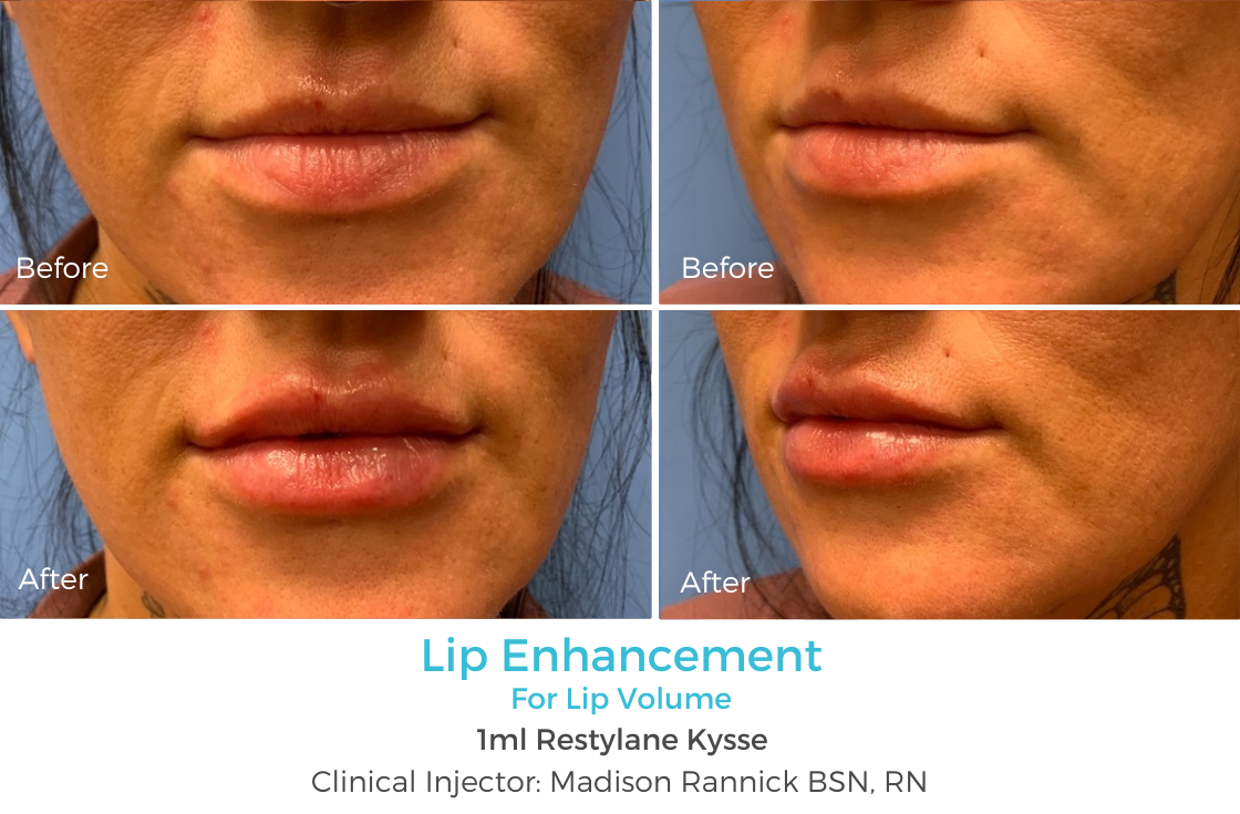 Lip Enhancement 73.png