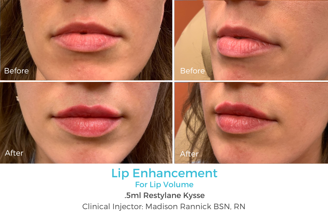 Lip Enhancement 74.png