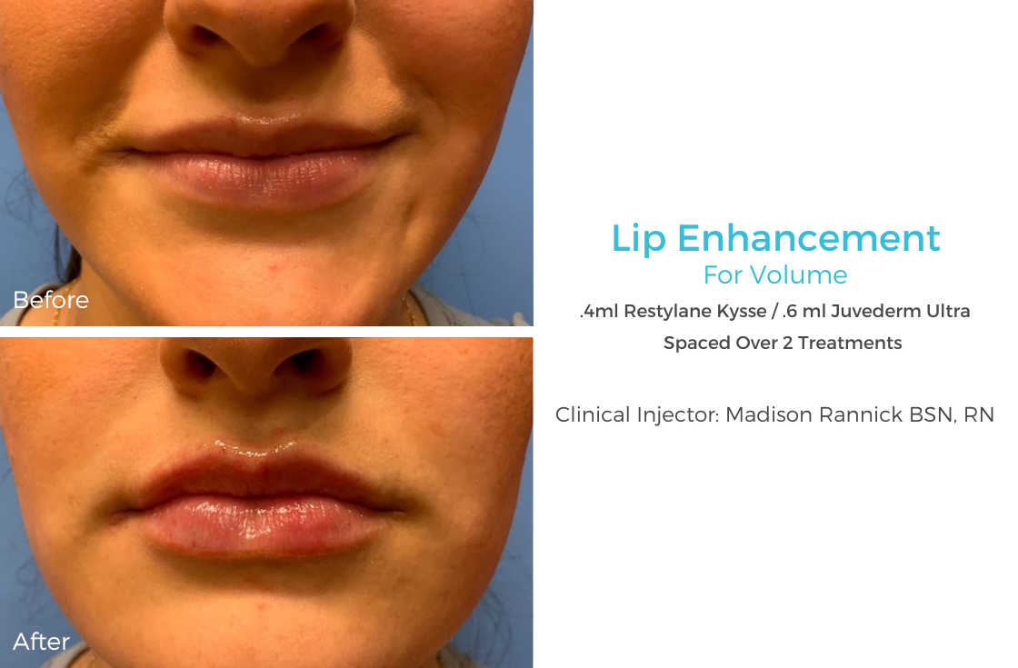 Lip Enhancement 83.png