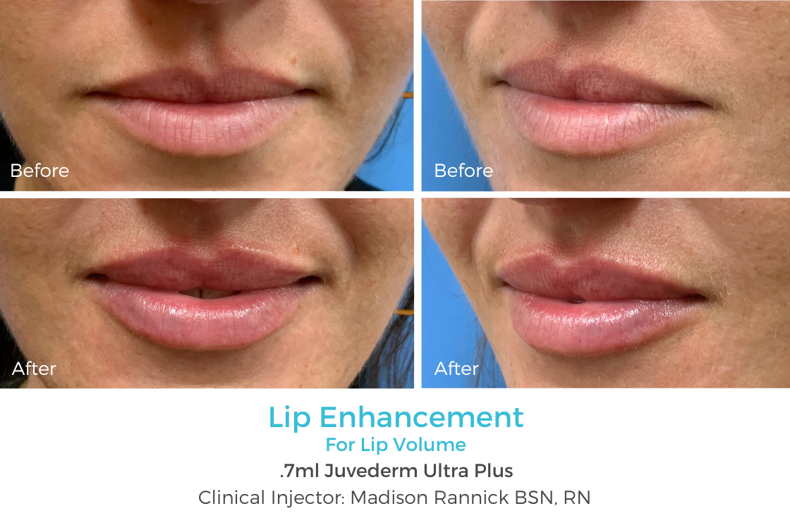 Lip Enhancement 87.png