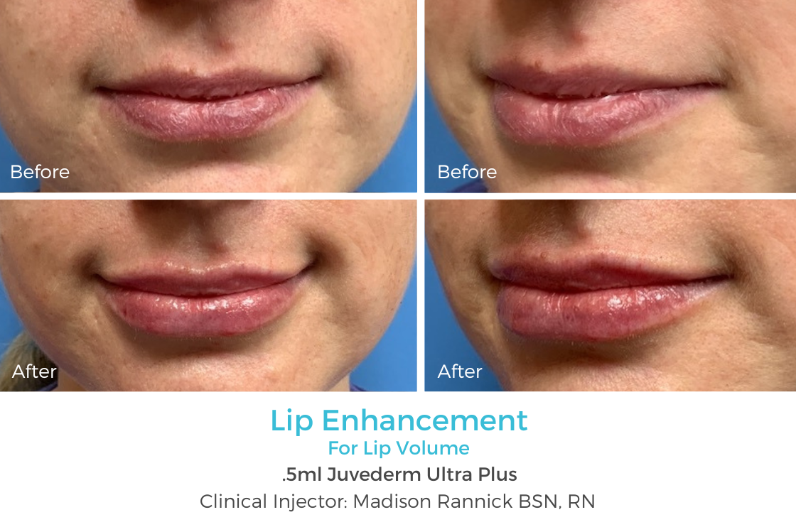 Lip Enhancement 88.png