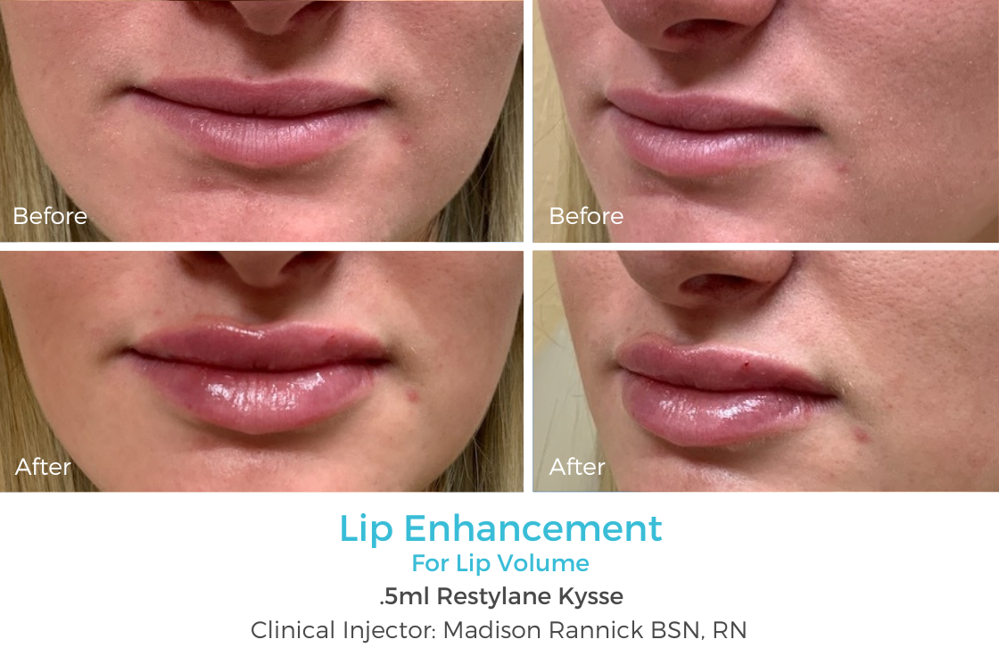 Lip Enhancement 93.png