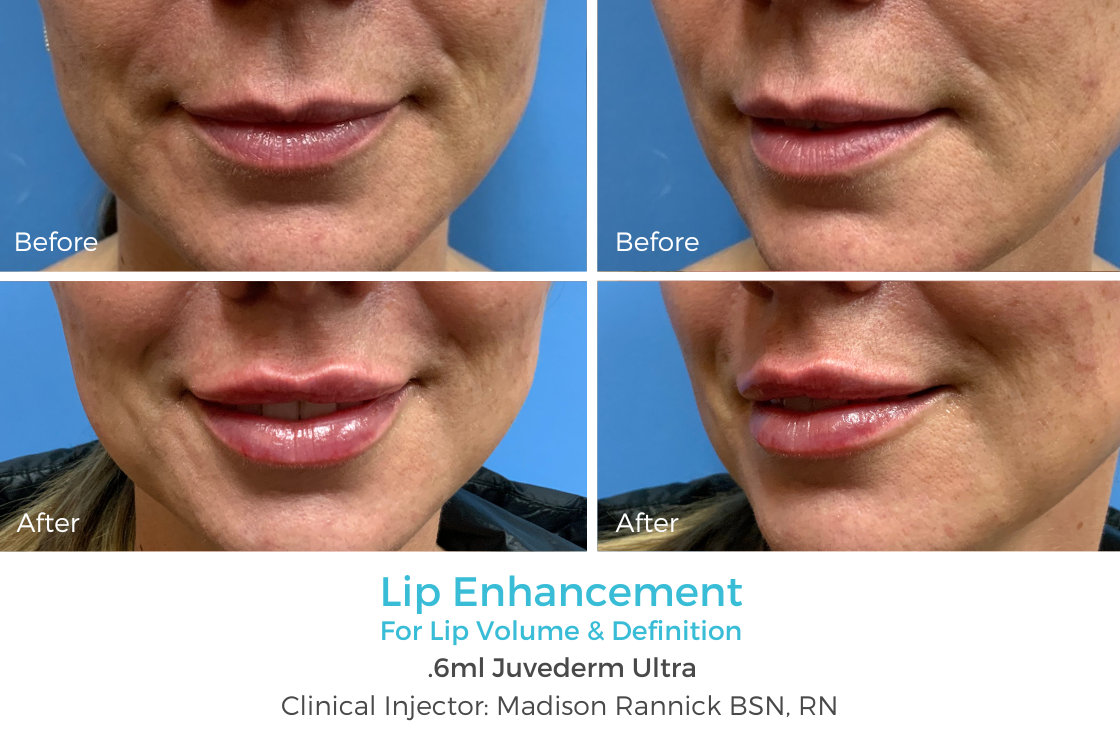 Lip Enhancement 94.png