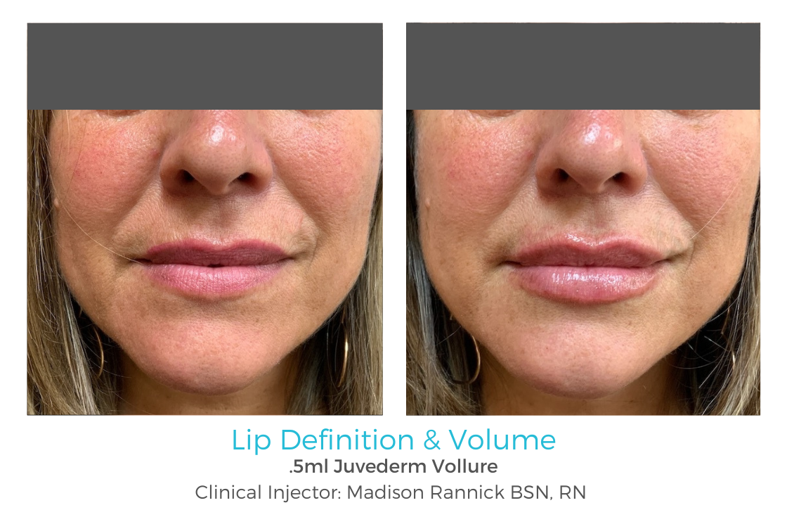 Lip Enhancement 89 11-06-23 Newsletter 04-01-24 .png