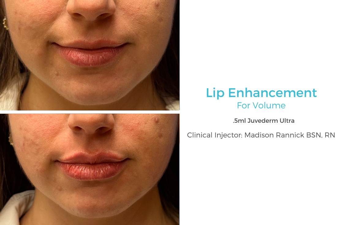 Lip Enhancement 95.png