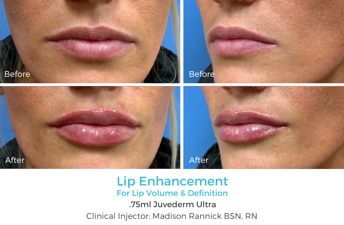 Lip Enhancement 97.png