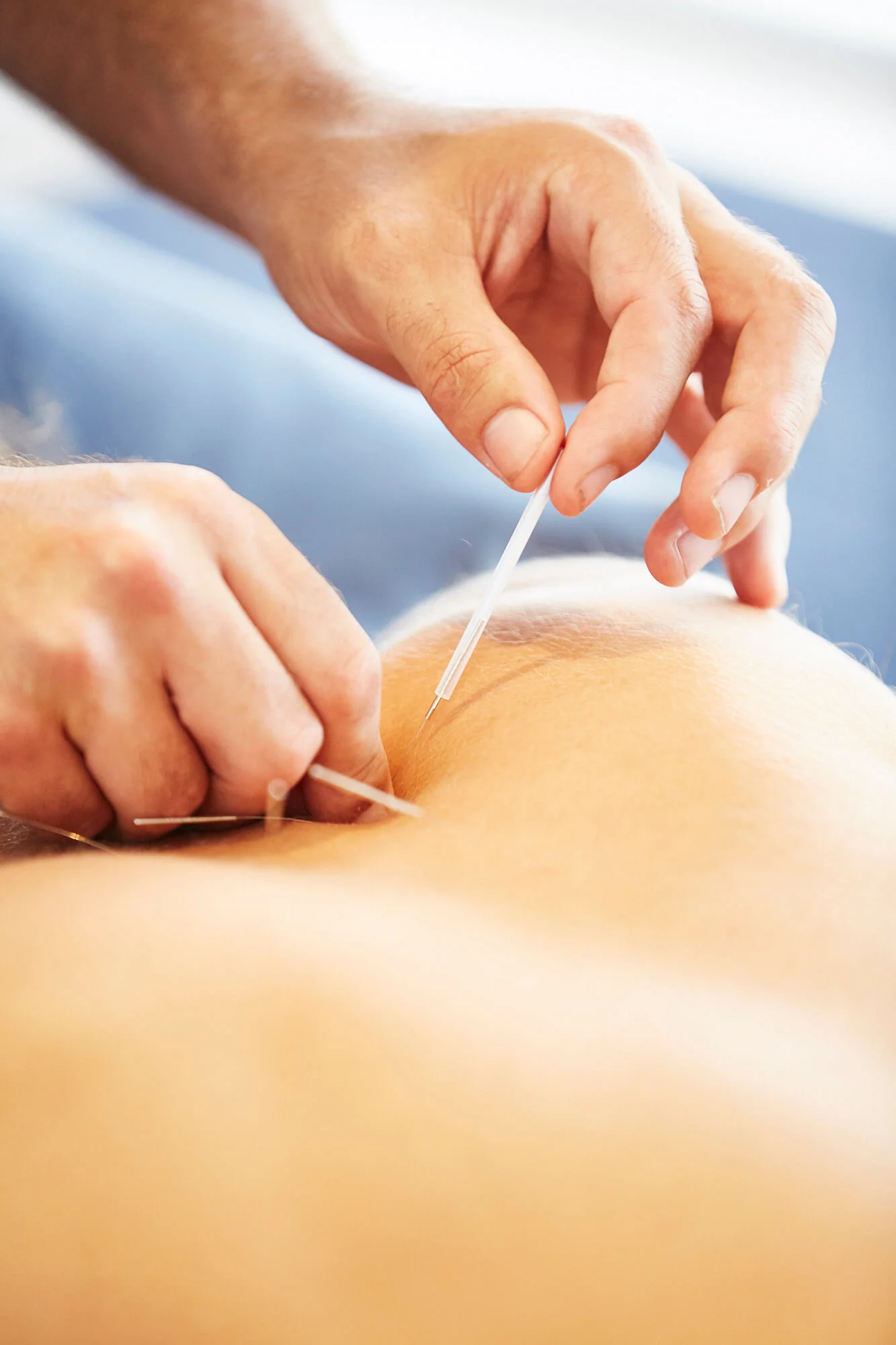 Needling 2.jpg