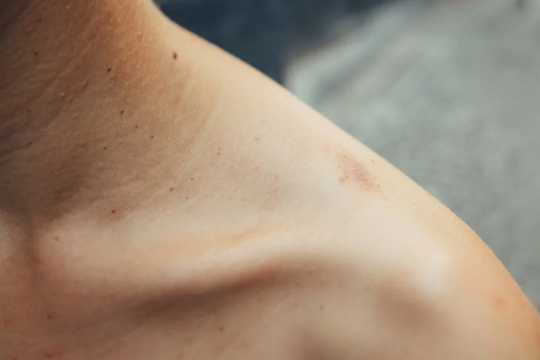 Been Given the Shoulder Bursitis or Rotator Cuff Injury Diagnosis? Ask yourself these 4 questions