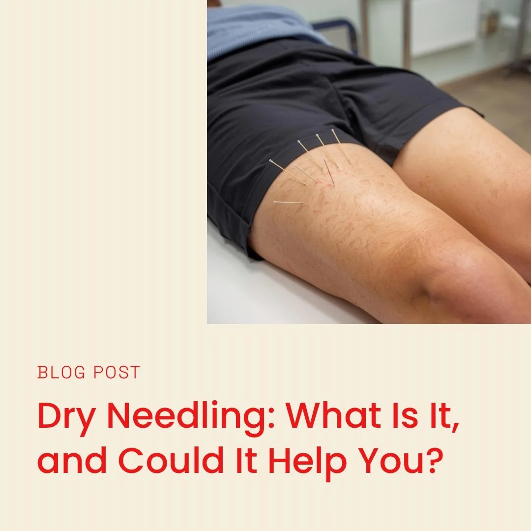 Dry Needling: What Is It, and Could It Help You?