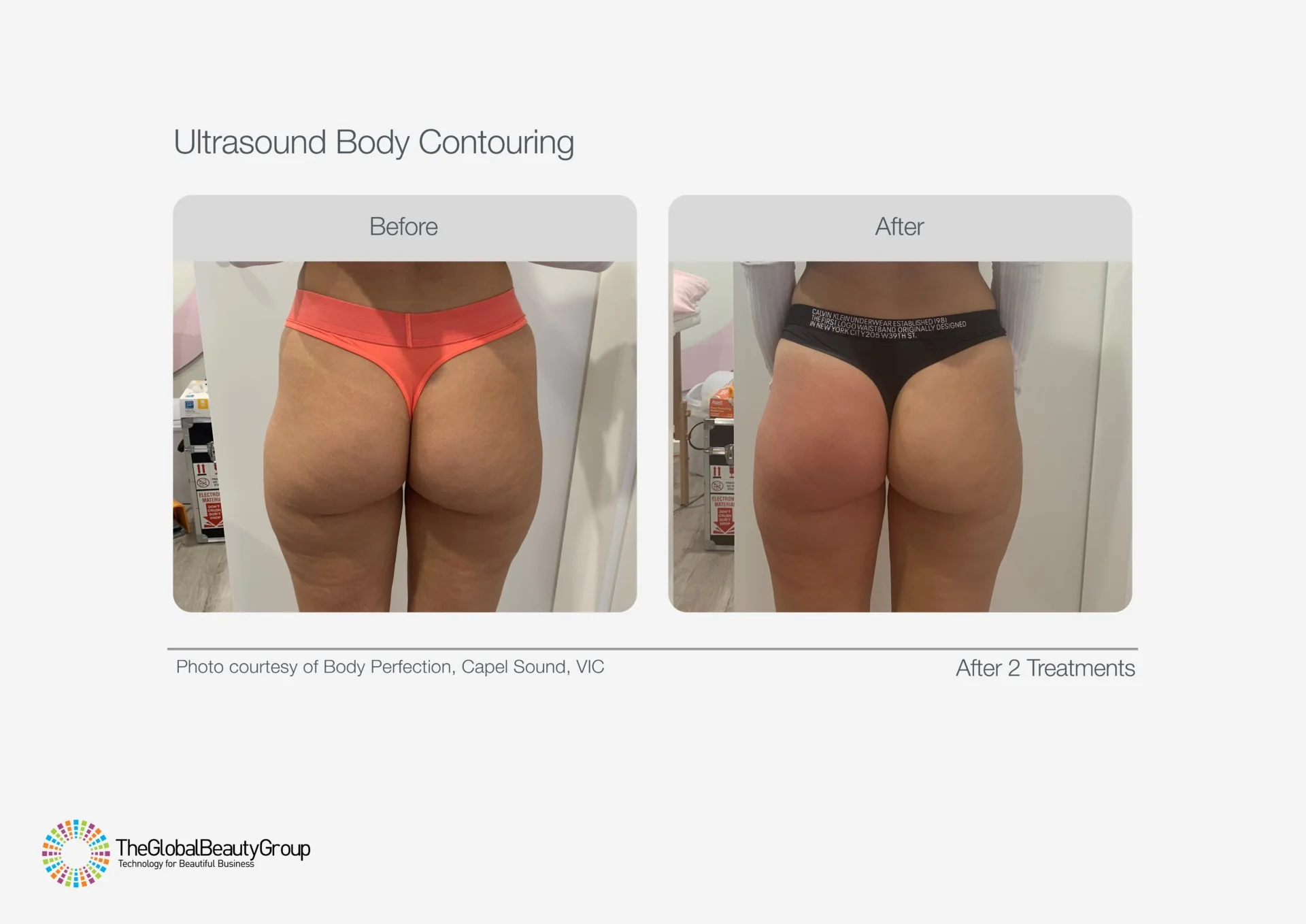 Ultrasound-Body-Contouring-Before-After-17-1920x1358.jpg