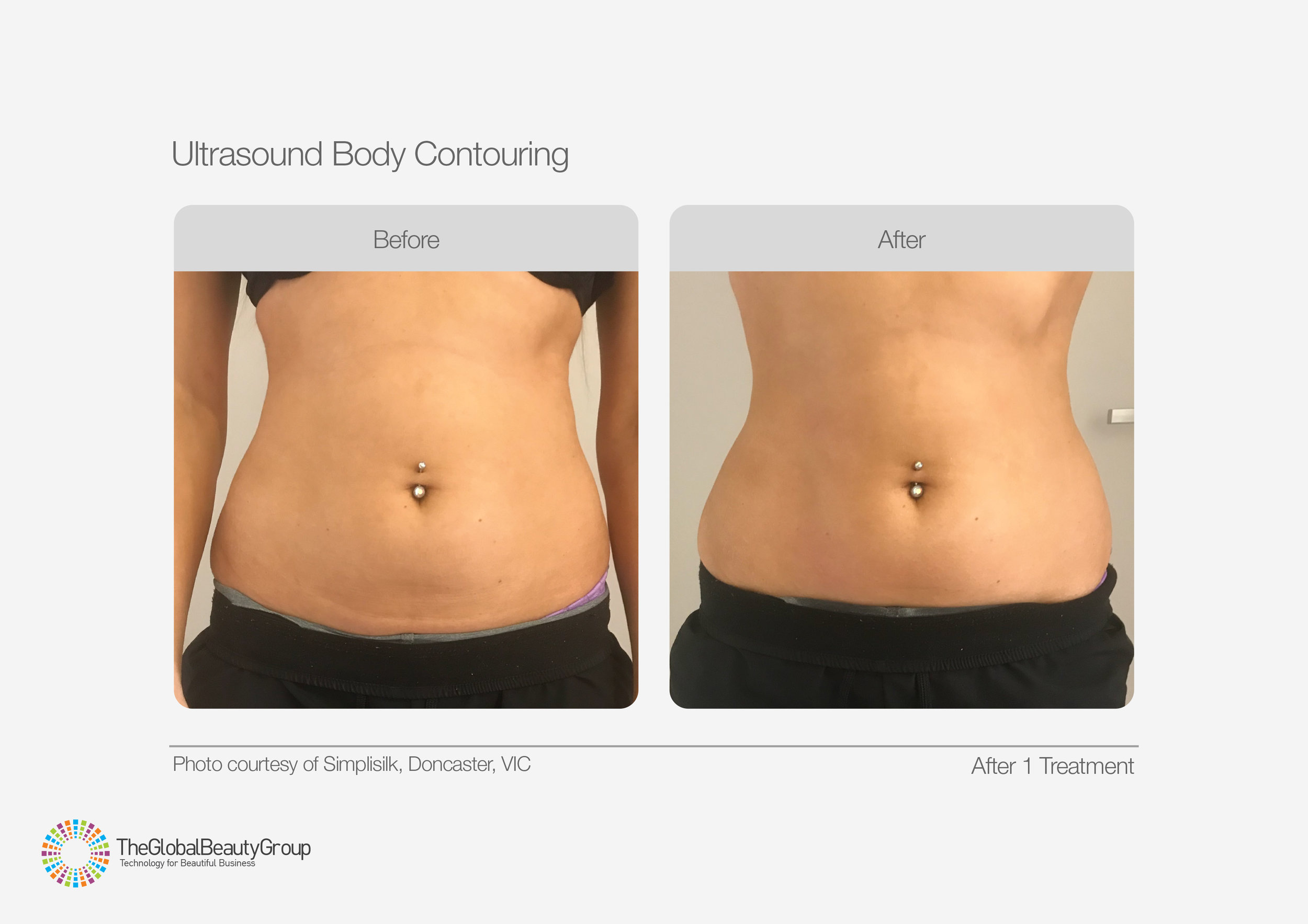 Ultrasound Body Contouring Before & After 15.jpg