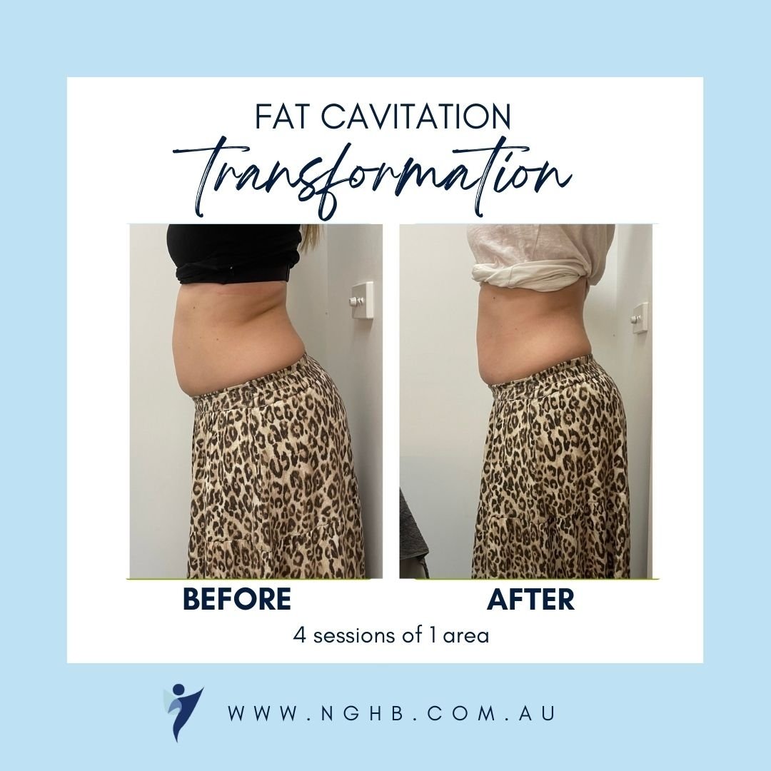 &quot;I can finally fit into my good jeans again!&quot;👖🙌
What an amazing transformation after just 4, ten minute sessions with us.  Our lovely client admitted to not changing anything whilst having the treatment (in fact Easter was bang smack in t