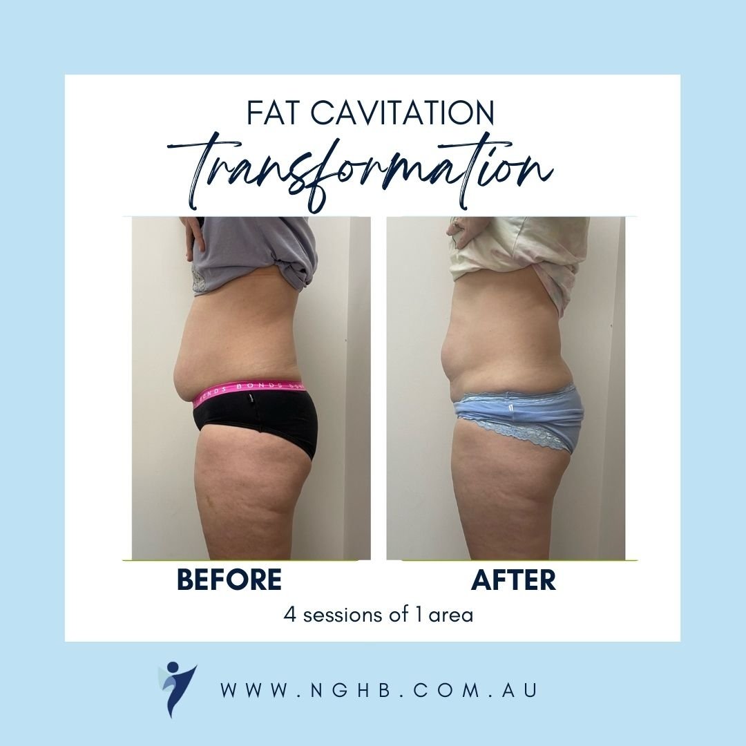 Another amazing transformation!  This is after just 4 sessions of ultrasound fat cavitation of lower abs.  Our beautiful client took advantage of the Autumn special - Buy 3 get one free which made each treatment only $48.75! 
Too good to be true?  NO