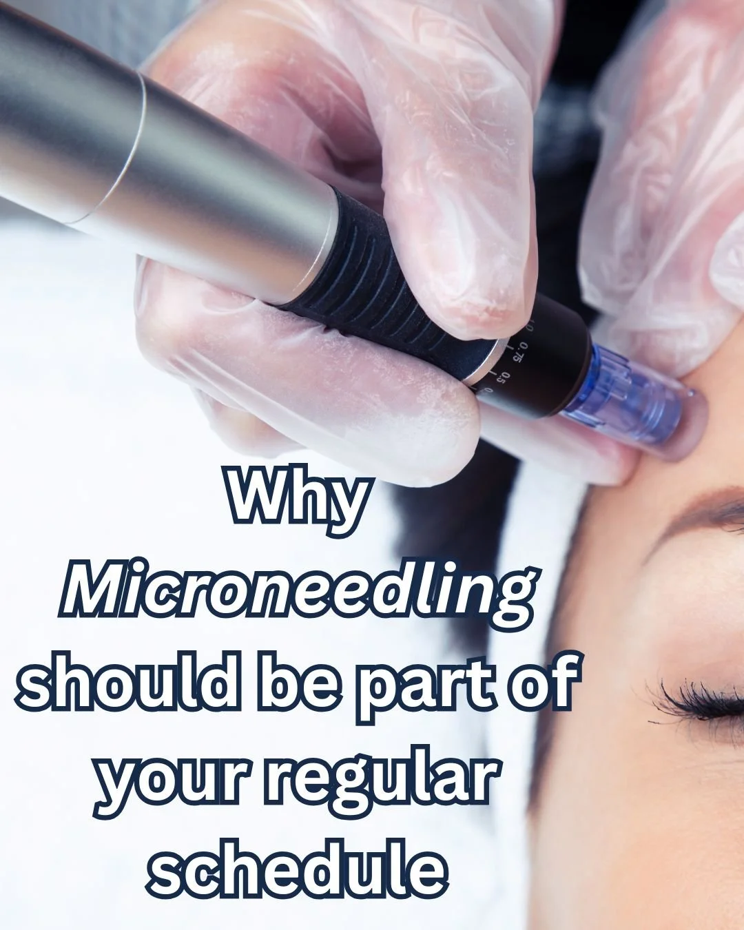 If microneedling isn&rsquo;t part of your skin journey yet&hellip; it should be.

Let&rsquo;s talk about one of the most transformative treatments you can add to your facial routine &mdash; SkinPen&reg; Microneedling.

This clinical treatment creates
