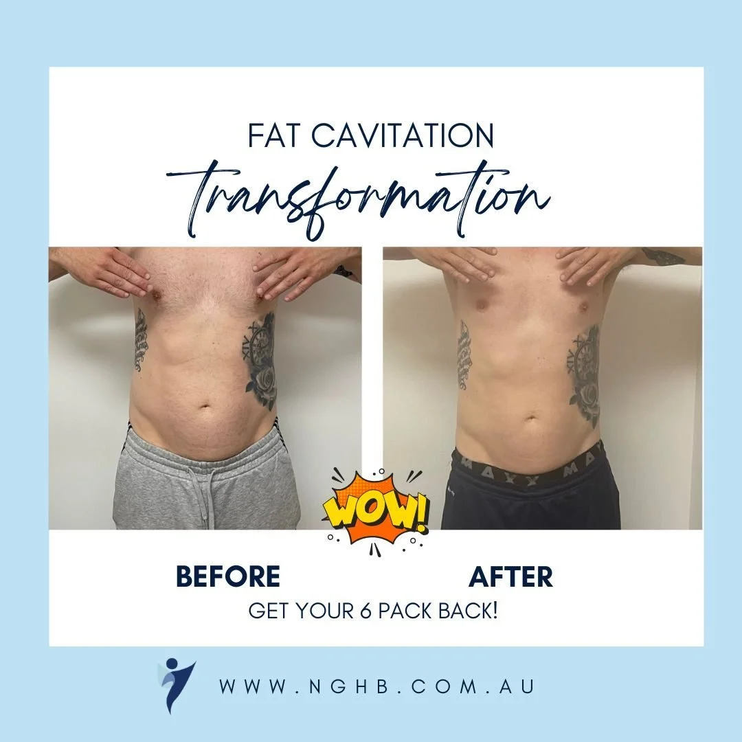 💪 It&rsquo;s not just for the ladies.

Men are getting incredible results with Ultrasound Fat Cavitation &mdash; just like this client who achieved serious ab definition by targeting those stubborn pockets of fat that don&rsquo;t shift, even with cl