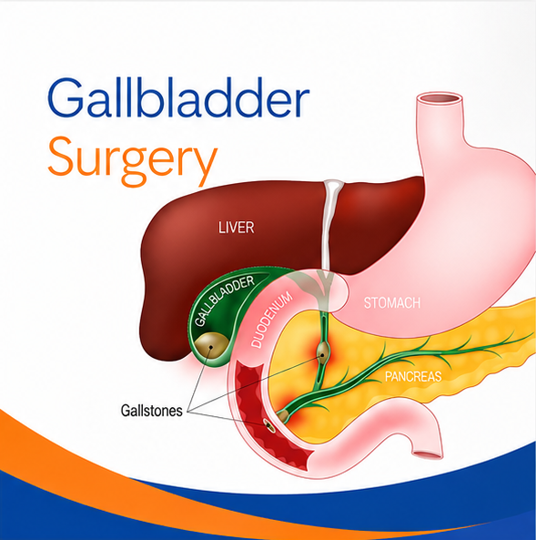 Anatomical diagram showing the gallbladder, gallstones, liver, stomach, pancreas and bile ducts used to explain gallbladder surgery.