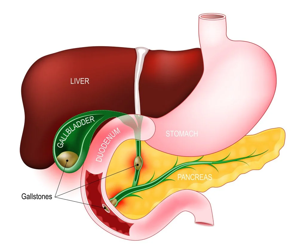 Illustrated anatomy of the gallbladder and liver with gallstones present. Gallbladder removal surgery is required to eliminate the risk of complications caused by the gallstones. Dr David Joseph offers Gallbladder Surgery in Sydney.