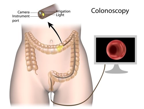 Screening Colonoscopy Plano