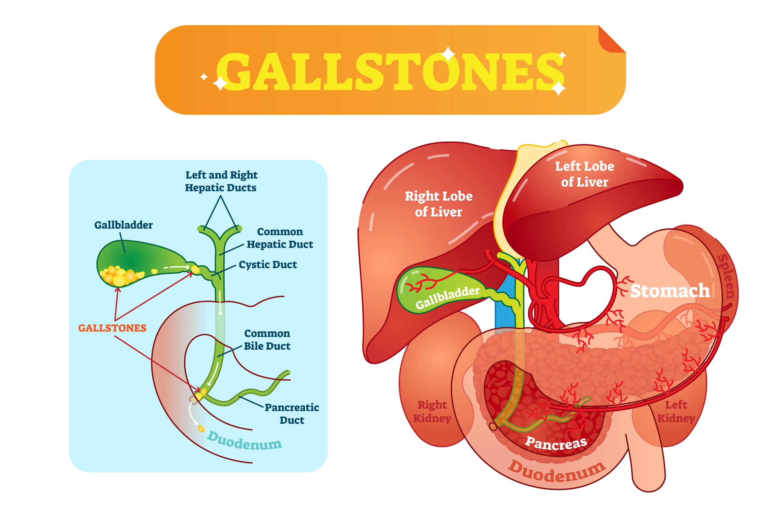 Gallstones - best gastroenterologist in OKC.jpg