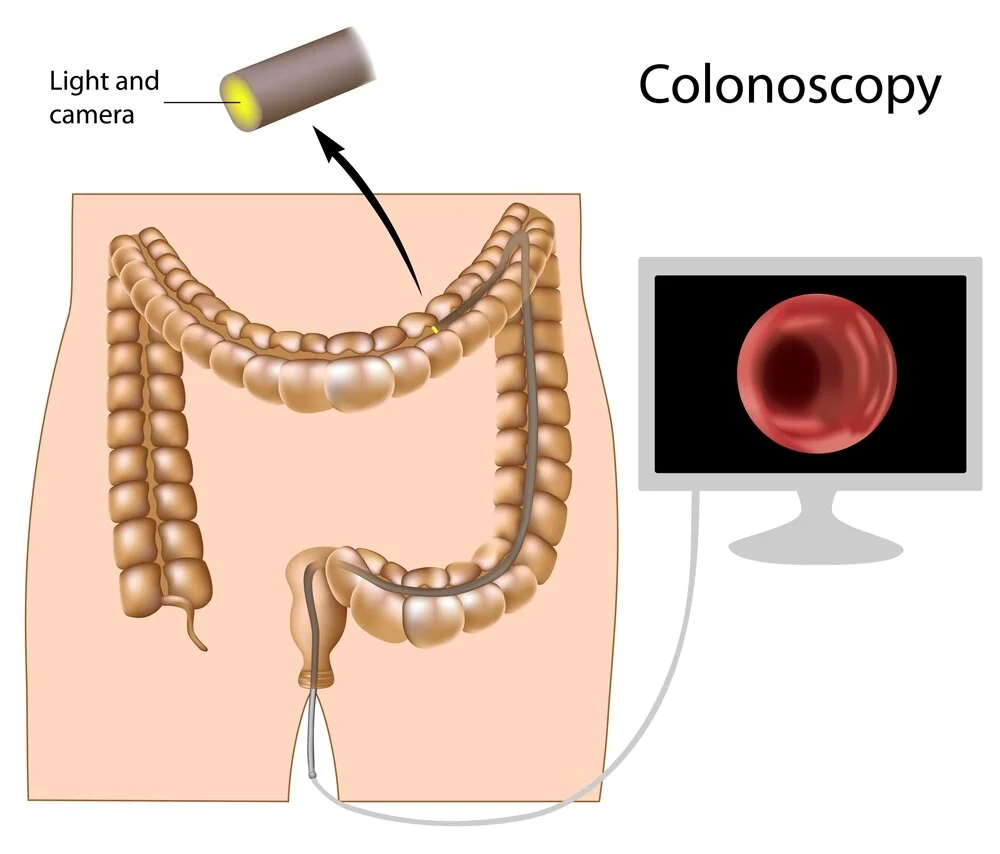 An Overview on Colon Cancer Screening