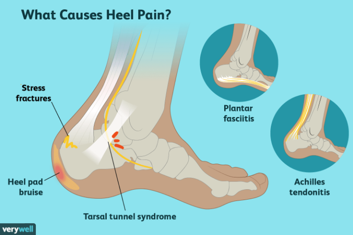 Why Heel Pain Won't Disappear - Foot and Ankle Podiatrists