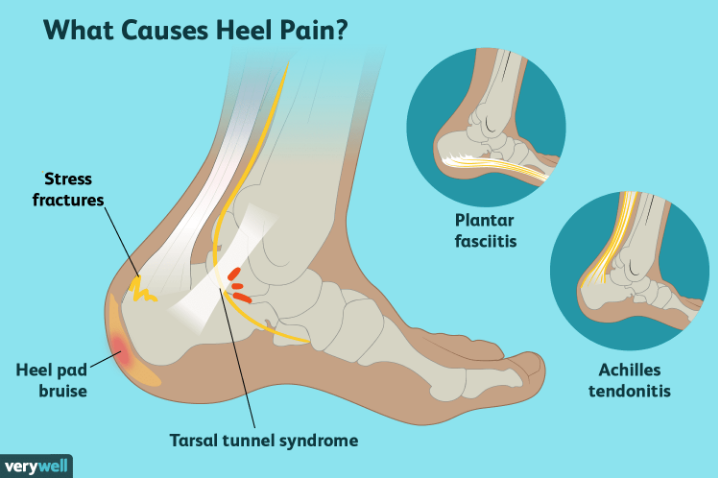 What Causes Heel Pain Foot Ankle Of West Georgia