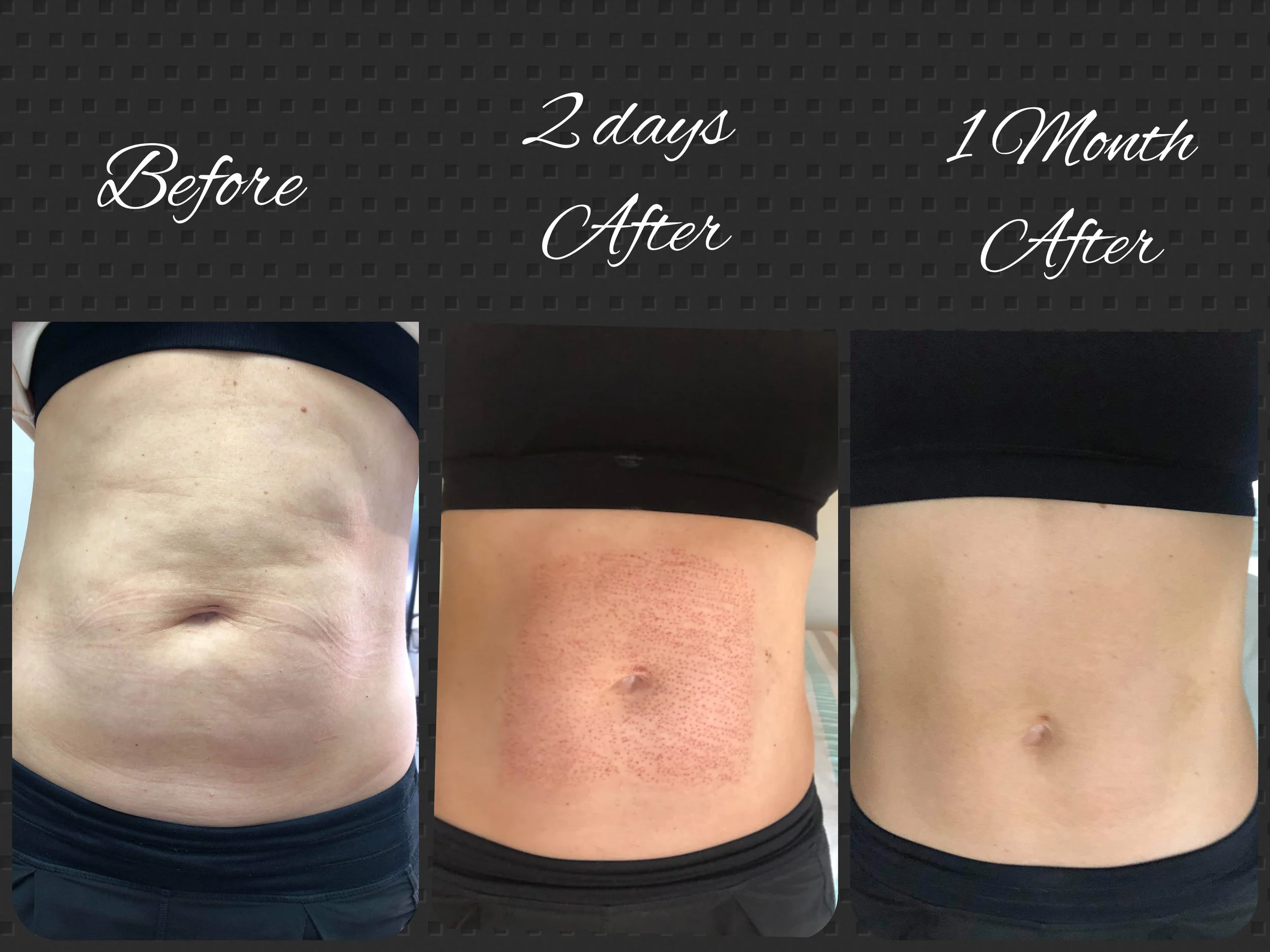 Note - This procedure does not help you loose weight, it tightens your excess skin. The above client had a c-section 3 years ago, and these were the results after the procedure to tighten her skin.