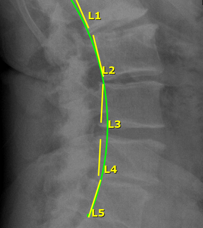 Low Back Pain X Ray