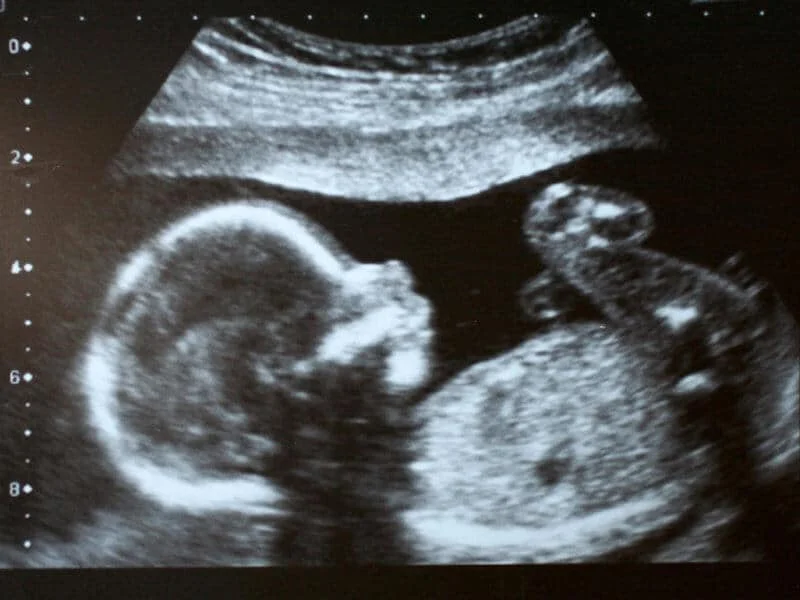 Pregnancy Announcement Ultrasound Scan Will and Kate