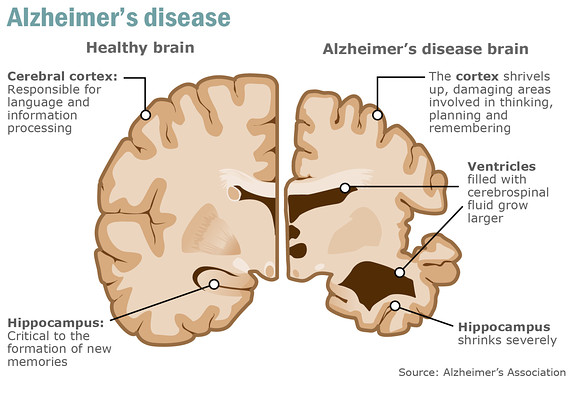 AD brain.jpg
