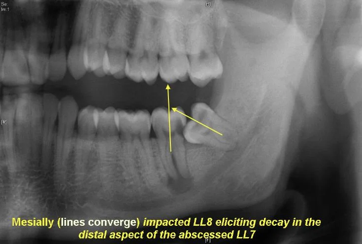 Mesially_impacted_LL8_eliciting_decay_in_LL72-735x495.jpg