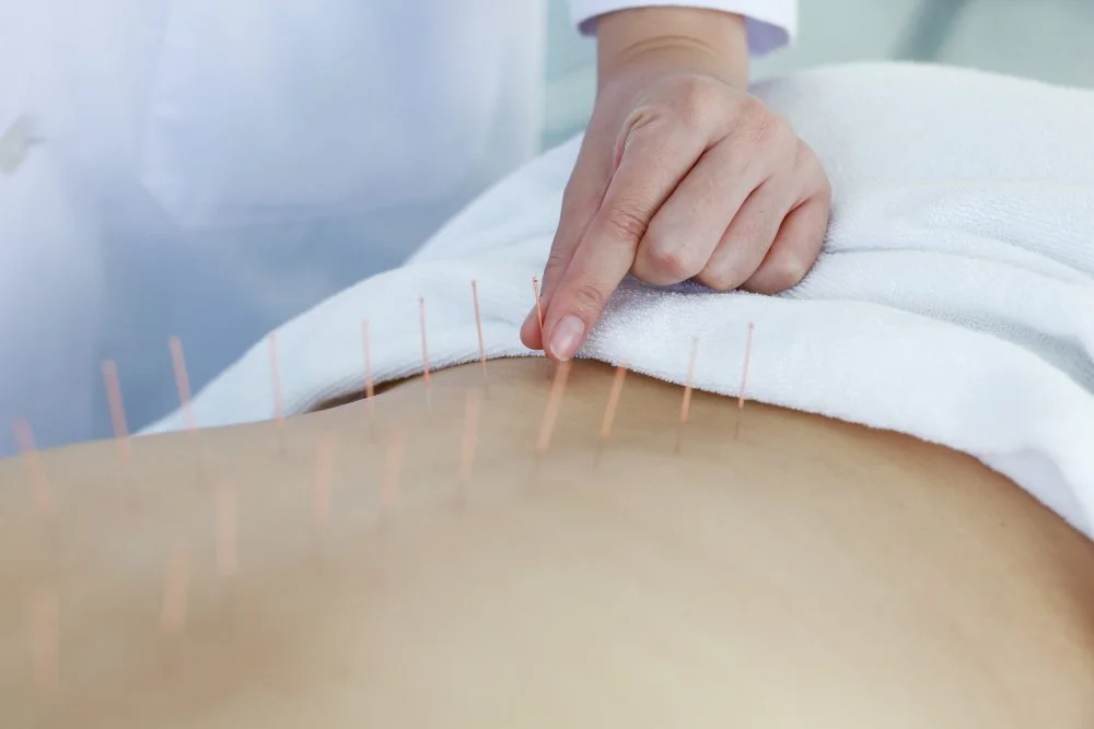 The Healing Art of Acupuncture for Sciatica Relief
