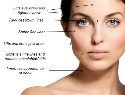 Ultherapy areas.jpg