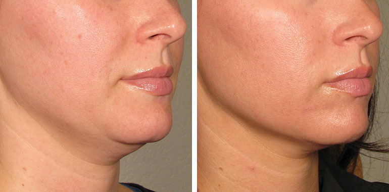 Ultherapy 01.jpg