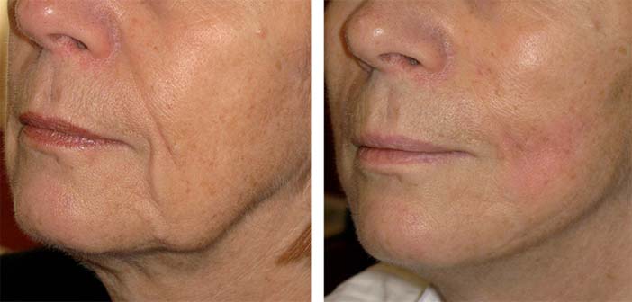 Ultherapy 02.jpg