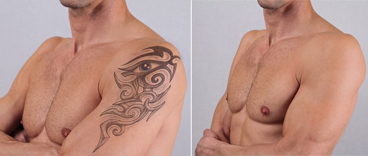Tattoo-Removal-man.jpg
