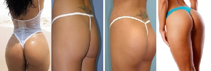 Butt lift.jpg