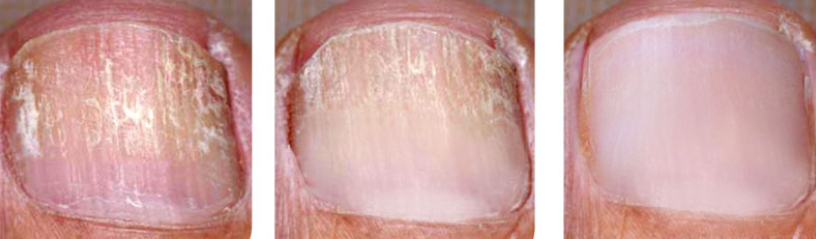 toenail 8 weeks after.png