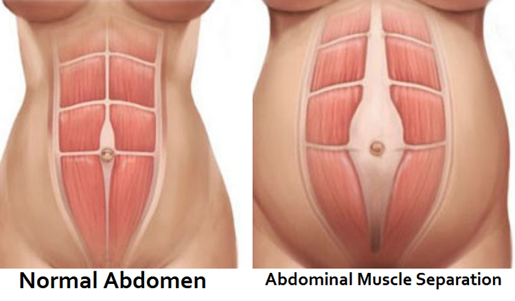 Abdomenal+Muscle+Separation - Copy.png