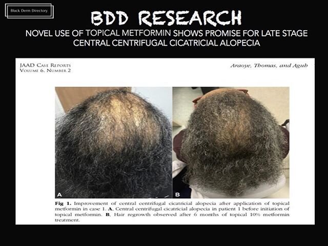 #Repost @blackdermdirectory
・・・
#blackdermdirectory .
.
.
Araoye EF, Thomas JAL, Aguh CU.  Hair regrowth in 2 patients with recalcitrant central centrifugal cicatricial alopecia after use of topical metformin.  JAAD Case Rep. 2020 Jan 22;6(2):106-108
