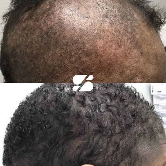 Awesome results by @dr.coreyhartman
 #blackdermatologist #blackdermdirectory ...........
#Seek the assistance of a #boardcertifieddermatologist who can rule out underlying systemic disease , #diagnose , provide multiple #treatment options for #hairlo