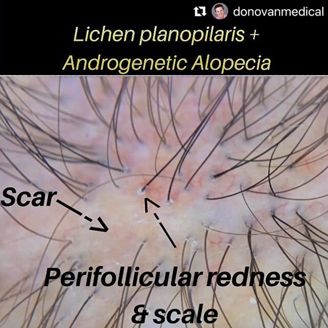 Check out @donovanmedical IG page for mini lectures on all things #hairloss  he is a world renowned hair loss expert
.
.
.

#Repost @donovanmedical with @make_repost
・・・
Typical trichoscopic image from a patient with lichen planopilaris and androgene