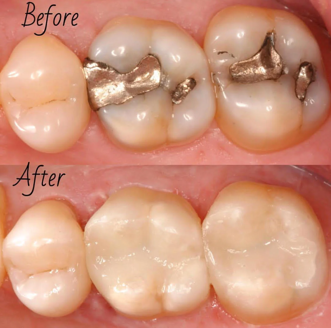 Mercury replacement with white fillings.