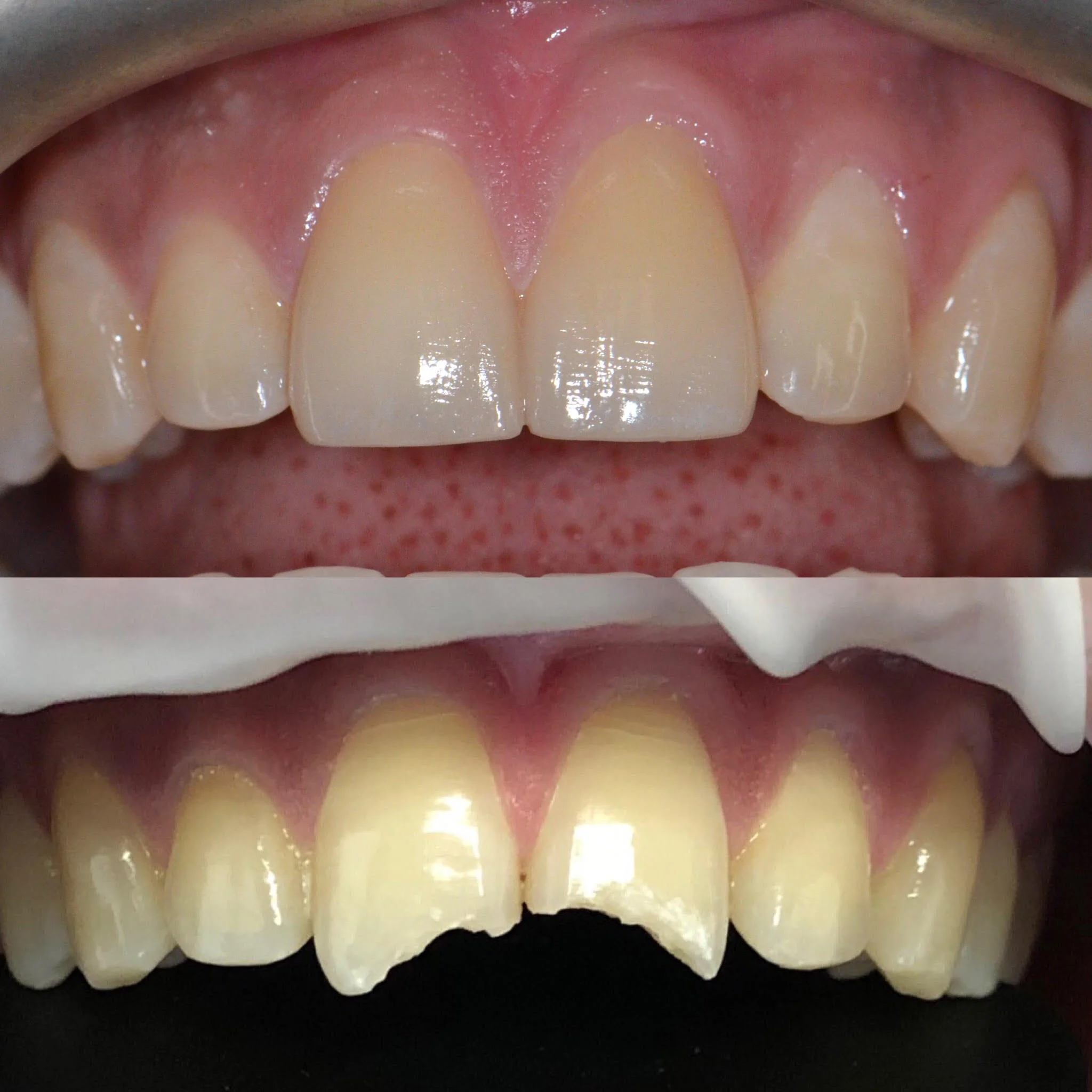 Two front teeth restored to its normal shape with Porcelain Crown.
