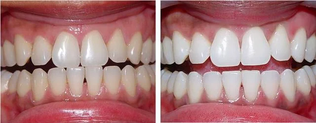 zoomteethwhitening.jpg