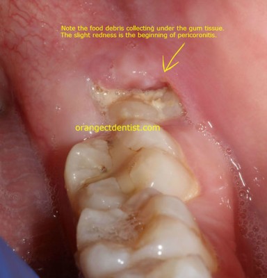 Pericoronitis_wisdom_tooth_dentist-784x400.jpg