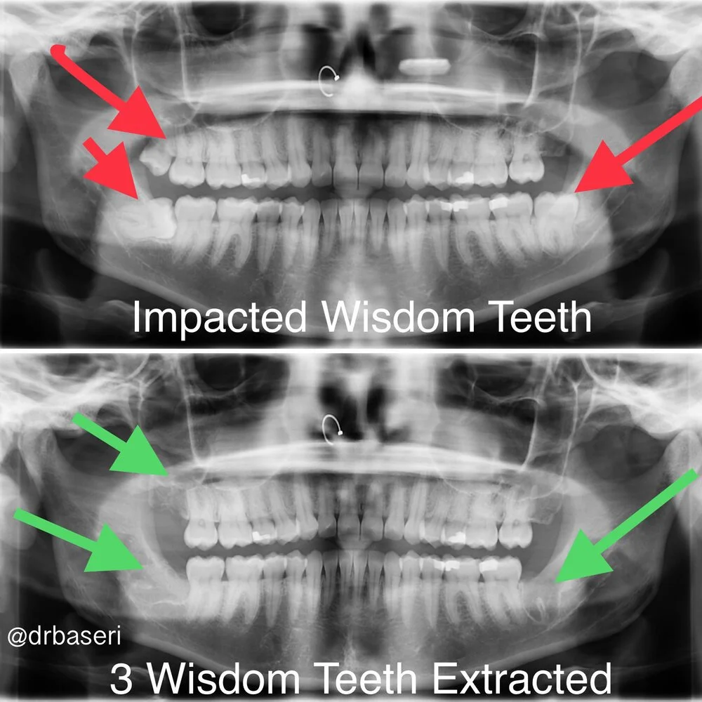 Before and After Impacted Wisdom Teeth Removal X-ray