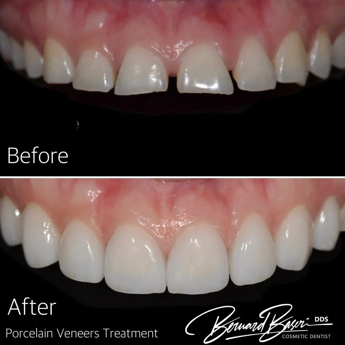 Full-mouth porcelain veneers and implants – before and after case Los Angeles