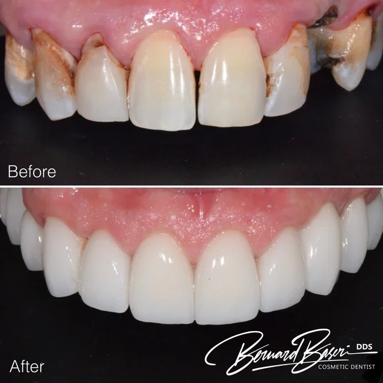 Porcelain veneers smile makeover – before and after upper teeth Los Angeles