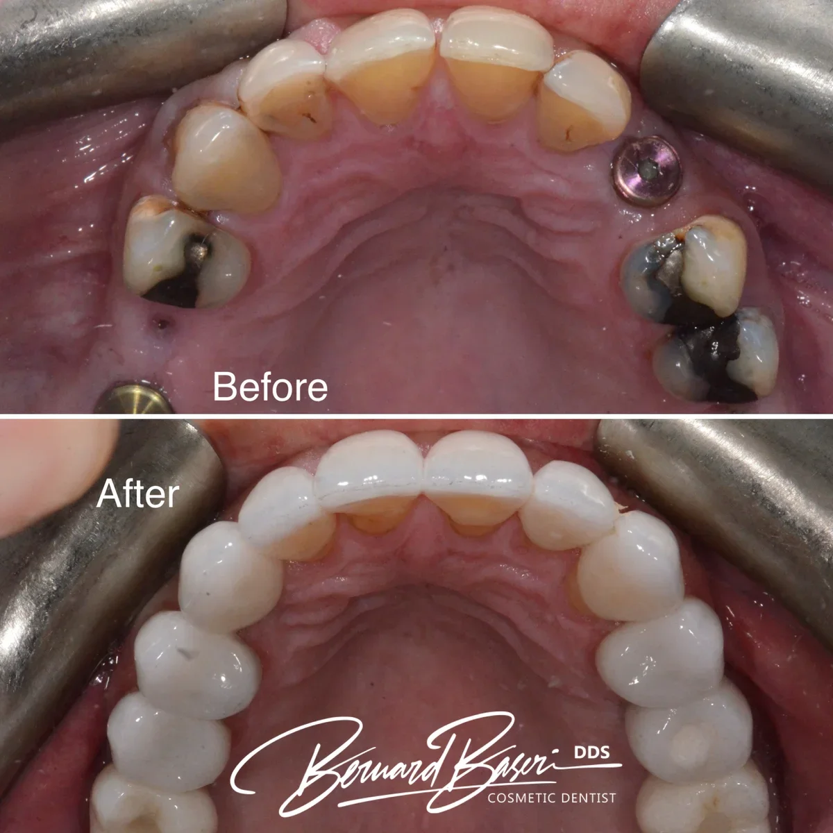 Upper-arch dental implants and veneers – before and after restoration Los Angeles